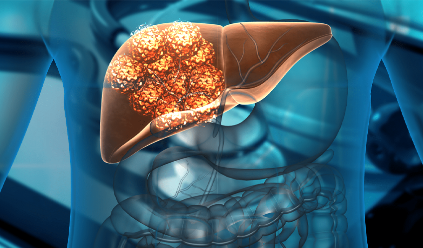 Liver Transplant in Alwarpet