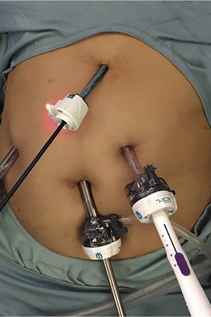 Liver Transplant Cost Alwarpet